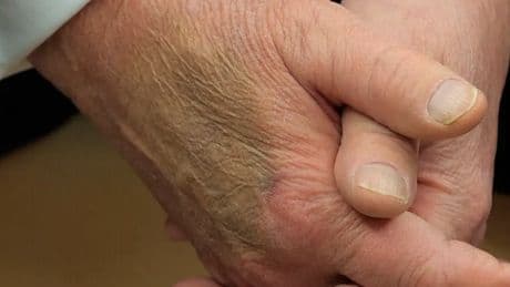 Por qué el visible hematoma en la mano de Trump puede ser el síntoma de algo más grave, según una cirujana