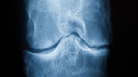 Gesundheit: Hyaluronsäure gegen Schmerzen im Knie – lieber nicht