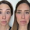 I got Botox on half my face to show others how it really affects your looks... here are the results