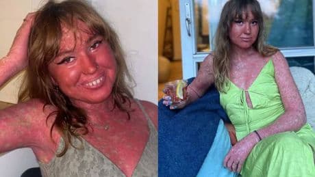 'My scaly skin is constantly peeling and growing, I've been called a monster but I feel unique'
