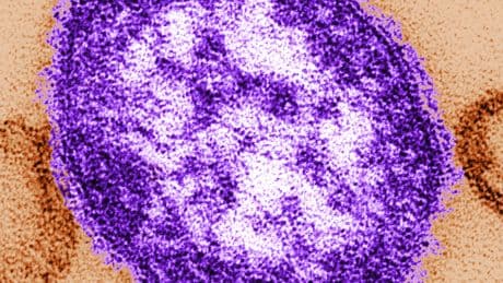 Measles exposure alert issued for communities south of Winnipeg
