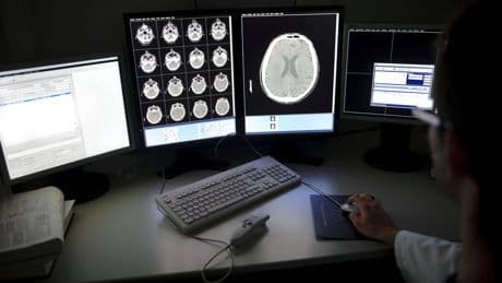 ‘Hope on the horizon’ as drugs assessed for Alzheimer’s prevention