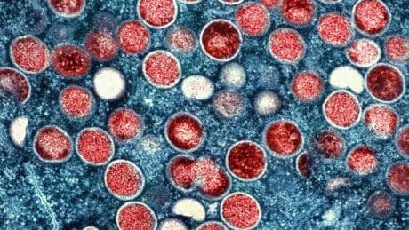 Krankheiten: Mehr Fälle von Mpox – aber Experte bislang gelassen