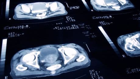 What are the symptoms of prostate cancer and how common is it as Joe Biden reveals diagnosis