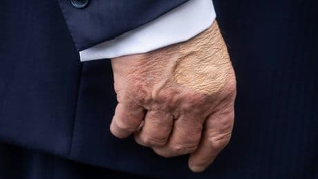 Donald Trump souffre d'une insuffisance veineuse chronique