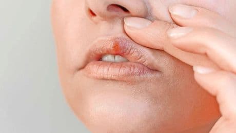 Wondje op de lip? ’Blijf er niet te lang mee lopen, kan voorstadium huidkanker zijn’