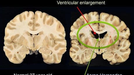 What is CTE? The neurodegenerative disease NYC gunman Shane Tamura claimed to have