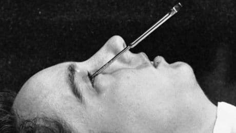 Des lobotomies aux interfaces cerveau-machines : neuf décennies de neurotechnologies à travers le monde