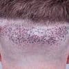 Hair transplant experts issue warning about UK clinics leaving men disfigured and depressed: 'Worse than Turkey'