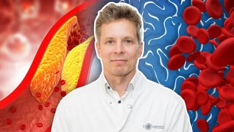 Hohes Schlaganfall-Risiko - oft steckt ein unbeachteter Wert dahinter