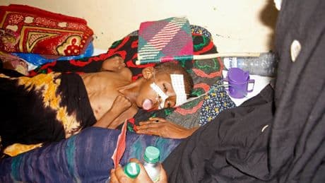 US aid kept many hungry Somali children alive. Now that money is disappearing