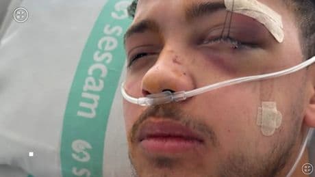 La brutal agresión a un árbitro de fútbol sala de 23 años: &quot;Tuve que pasar por quirófano, me han puesto cinco placas en la cara&quot;