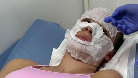 Teen 'traumatised' as extreme sunburn on first day in Thailand blisters whole face
