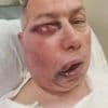 Cricket umpire left unrecognisable with horror facial injuries but says he ‘feels like he won lottery’