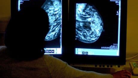Unlikely treatment linked with longer survival in breast cancer study