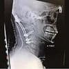 Doctors reattached my head after I was 'decapitated' in a car accident
