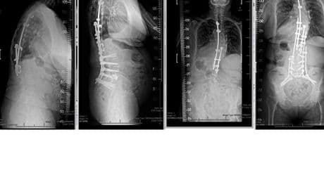 Scoliosis Awareness Month: AI & Big Data Transform Patient Care
