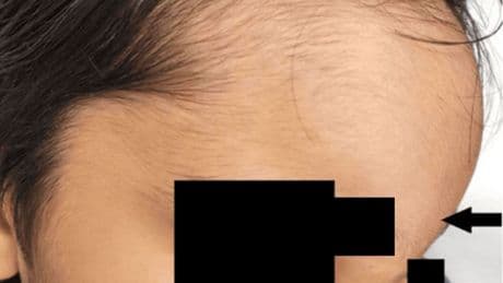 ‘Healthy’ boy, 8, left with giant forehead and lethal swelling after blocked nose turned into ‘Pott’s puffy tumour’