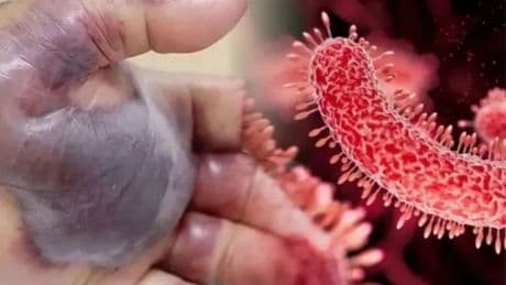 Et yiyen bakteri kabusu türkiye sahillerinde! Bu belirtileri görürseniz denize sakın girmeyin