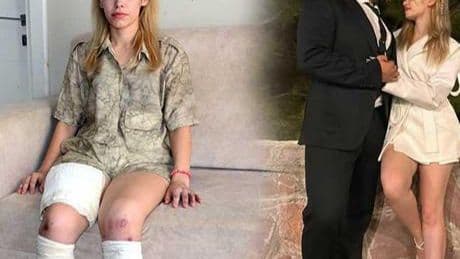 Fitness eğitmeni en mutlu gününde 2 bacağını kaybetti! ‘Evlilik yıl dönümüm cehenneme döndü’