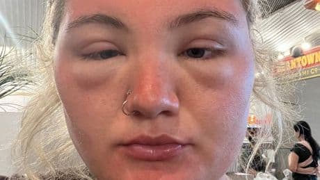 'Severe sunburn ruined my holiday - my own mum couldn't recognise me'