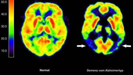 EU-Kommission lässt erstmals Antikörper-Medikament gegen Alzheimer zu