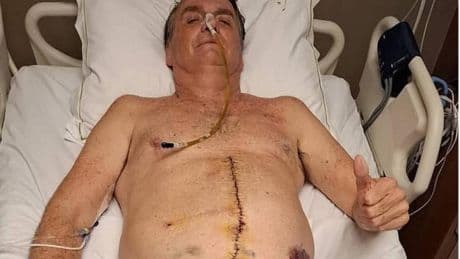 Bolsonaro circula en redes una foto de sus intestinos durante una intervención quirúrgica