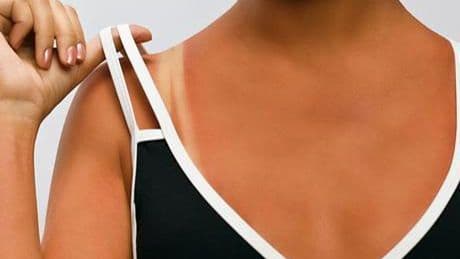 Yazın bronz tenli olmak çok moda! ‘Sağlıklı bronzlaşma diye bir şey yok’