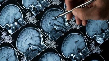 Alzheimer, la stimolazione magnetica transcranica frena la malattia: dopo un anno un rallentamento del 52%