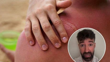 David Callejo, anestesista y experto en salud: "El bronceado es un mecanismo de defensa de tu piel"