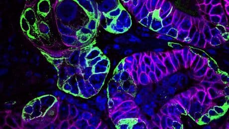 Scots scientists make key discovery in how bowel cancer is able to disguise itself