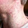 Cases of the world's most infectious disease keep climbing in the UK - with two major areas most at risk