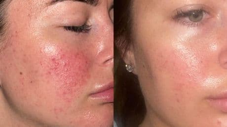 Shopper 'couldn't go a day without a spot' until they found this dermatologist-approved serum