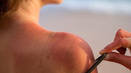 Revolucionario hallazgo en cáncer de piel: un estudio descubre el potencial de un virus común frente al melanoma