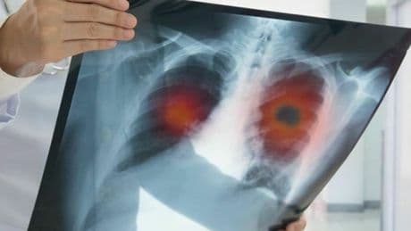 Tumore ai polmoni, lo smog è causa anche dei non fumatori. Lo studio: «Danneggia il Dna come le sigarette»