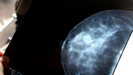 Tumore al seno: nuova molecola blocca le metastasi