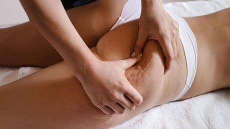 Crèmes, massages, cryolipolyse, laser... Que valent vraiment les traitements anticellulite ?