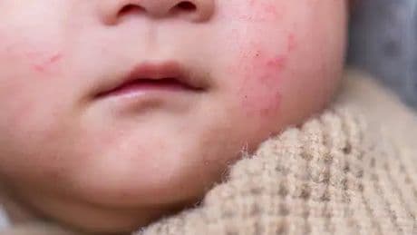 Besin alerjilerine dikkat: Anne sütüyle de geçebiliyor!