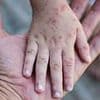 New York City preparing for outbreak of SECOND 'highly contagious' virus... as cases spread to neighboring states