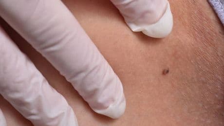 Skin expert shares why everyone should look out for ‘ugly duckling’ moles