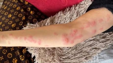 Woman covered in agonising burns after wholesome day picking blackberries