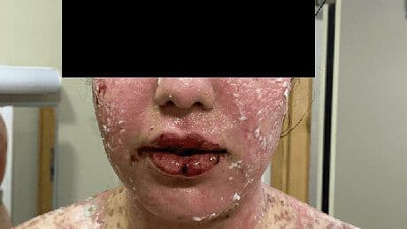 Woman, 24, watched a third of her skin ‘peel and detach’ from her body just four days after taking routine NHS drug