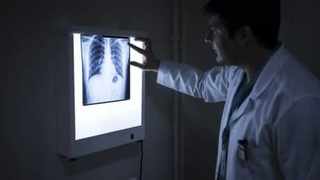 ¿Qué es la amiloidosis? Así son los síntomas de la enfermedad que engaña y confunde a los médicos