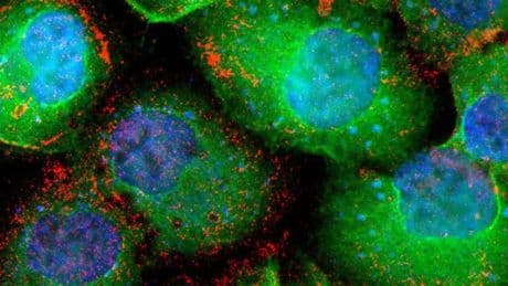 Revolución en oncología: los tratamientos triplican la esperanza de vida con cáncer de próstata avanzado