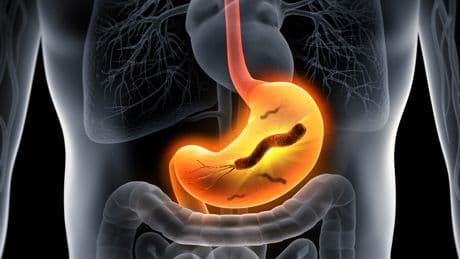 La bactérie Helicobacter pylori pourrait provoquer des millions de cas de cancer de l’estomac dans les années à venir