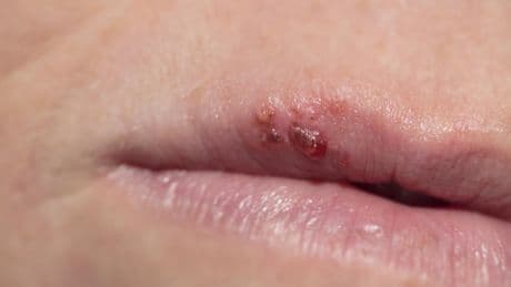 Un gran estudio vincula la aparición de herpes labiales con un mayor riesgo de alzhéimer: el hallazgo científico