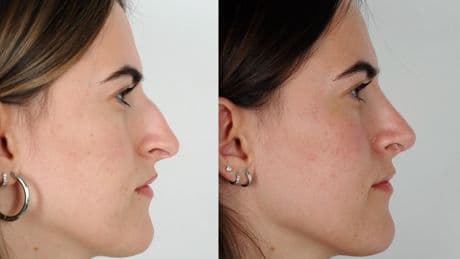 La rinoplastia ultrasónica, clave en la estética nasal