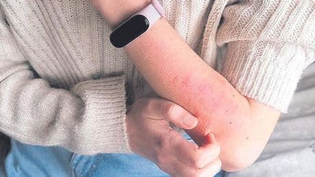 ¿Qué es la sarna? ¿Los afectados deben aislarse? Siete claves de una infección desbocada entre los jóvenes