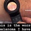 Skin cancer doctor shares shocking video of 'worst melanoma' he's ever seen: 'They don't always look like moles'