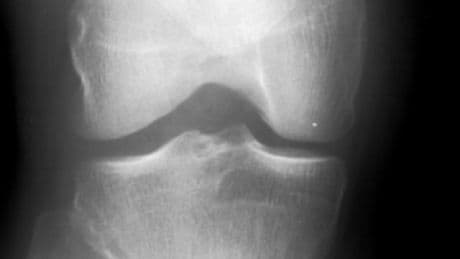 This small walking style change can delay knee surgery for years, study finds